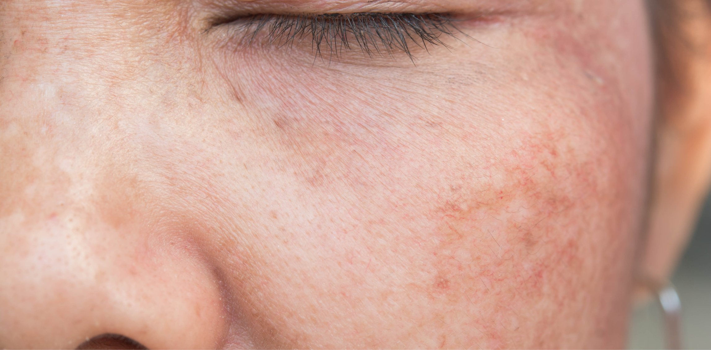 How To Protect Your Skin From Hyperpigmentation