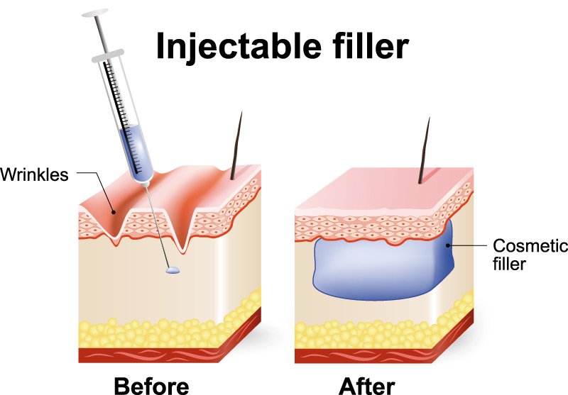 Diagram showing cross section of skin showing fillers injected under the outermost layer of skin to lift and smooth wrinkles.